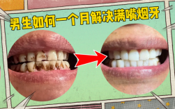 烟黄牙变白的简单方法