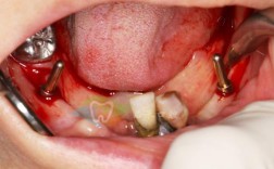 衡阳附二种植牙怎么样？价格和技术靠谱吗？