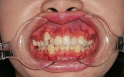 尖牙牙根突出可以进行正畸矫正吗？