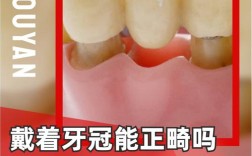 有烤瓷牙能做正畸矫正吗？