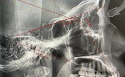 正畸前都必须拍牙片吗？拍牙片是必须步骤吗？