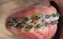 正畸挂皮筋多久手术