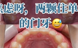 牙齿矫正能改变嘴型吗