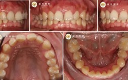 正畸不拔牙效果真的好吗？病例展示详解适用情况与效果对比