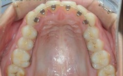 舌侧隐形微正畸技术