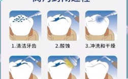 窝沟封闭的方法和步骤是怎样的？具体操作流程如何？