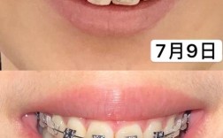 正畸三个月的片子