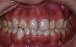 牙正畸失败后遗症