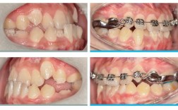 正畸中拱形效应如何实现牙齿精准排列与移动？