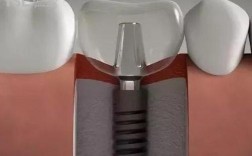 正规水激光种牙哪里可以做？求推荐靠谱地点