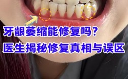 牙齿矫正会导致牙龈萎缩吗？