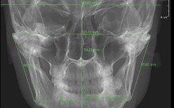 颞下颌关节盘前移正畸