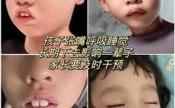 青少年口呼吸面容正畸能矫正出好脸型吗？