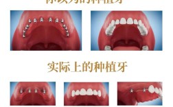 半口牙全缺失种牙，究竟要植几颗才够？