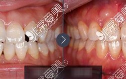 南京华美牙齿矫正效果好不好？价格贵不贵？