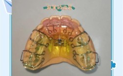 牙齿反颌活动矫正器的矫正效果究竟如何？