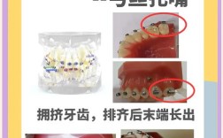 正畸治疗中末端不回弯具体会有什么影响？