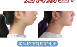 牙齿矫正下巴歪，是矫正不当还是其他原因？