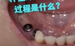 种牙第二手术到底疼不疼？过程痛感能忍受吗？术后恢复期会有哪些不适？