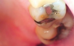 树脂补牙后正畸脱落，是材料影响吗？