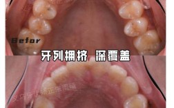 正畸牙弓拥挤9mm