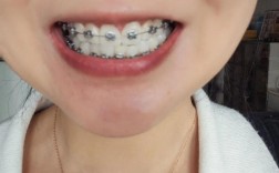 正畸铁丝长牙龈里了