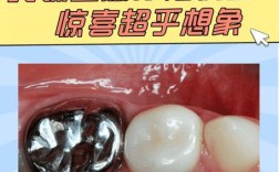 种植牙纯钛材料好吗？安全耐用吗？