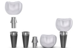 种牙的材料那种好