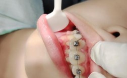 正畸自锁托槽粘接视频