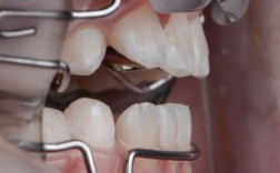 正畸术语Frankel的正确读音是什么？