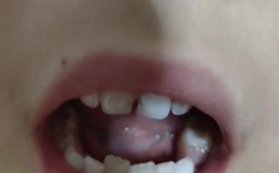 儿童正畸牙齿后，会有哪些后遗症？