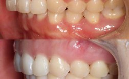 牙齿矫正2年多了还没结束？效果到底怎么样？