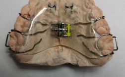 正畸戴螺旋簧是什么感觉？牙齿会有酸胀疼吗？多久能适应这种矫治力？