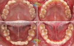 南京insignia正畸效果如何？值得选择吗？价格贵不贵？