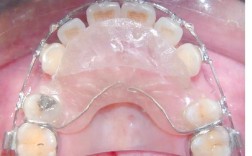 正畸活动式矫正器图片主要展示哪些佩戴效果与类型？