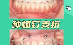 矫正牙齿打钉子带多久