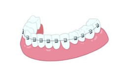 牙齿矫正反弹，究竟是什么原因在作祟？