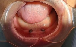 康贝佳口腔种植全口牙多少钱？效果真的好吗？