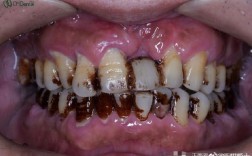 矫正牙齿为何会被腐蚀？