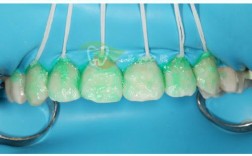 树脂临时冠正畸