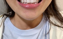 20岁矫正牙齿晚不晚？现在开始还来得及吗？