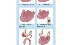 全口种植牙一般需要种几颗？
