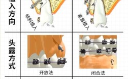 支抗设计与方法