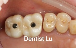 种植牙为何容易食物塞嵌？日常护理要注意什么？