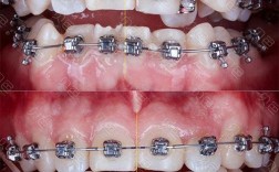 正畸推簧应用文章