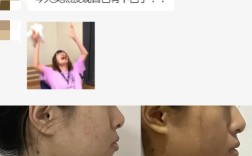 下巴后缩矫正日常方法