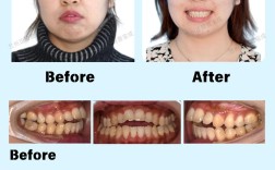 开颌矫正，正畸与手术，哪种选择更优？