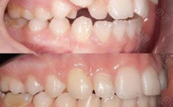 虎牙缺失正畸能恢复吗？前后变化大吗？
