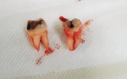 永川拜博口腔拔智齿疼不疼？价格贵吗效果如何？