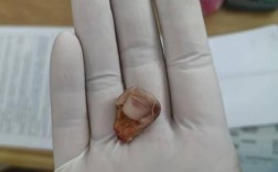 种牙钉子帽掉了是何原因？需重新处理吗？